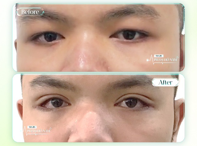 Trường hợp cắt mắt 2 mí BS Phạm Hồ Nam